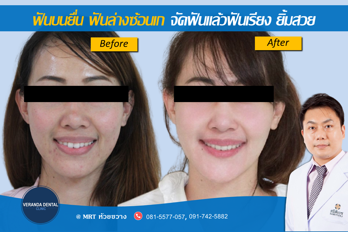 จัดฟันแก้ปากอูม
