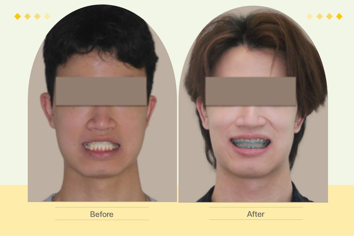 รีวิวแก้คางยื่น