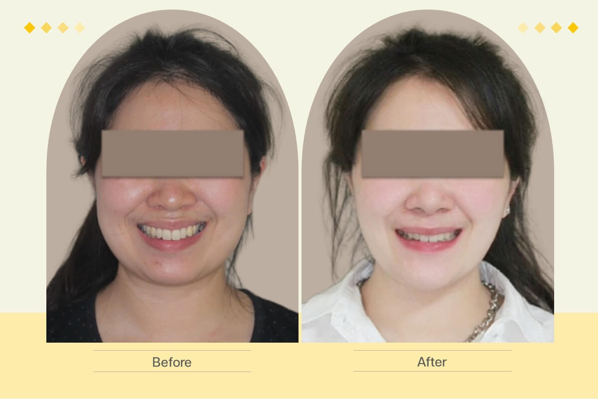 ยิ้มสวยขึ้นด้วยการจัดฟันแบบดามอน