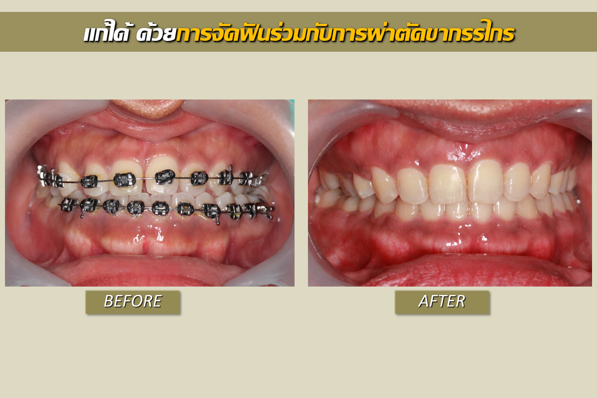 คางยื่นจัดฟันอย่างเดียวไม่ช่วยให้ดีขึ้น