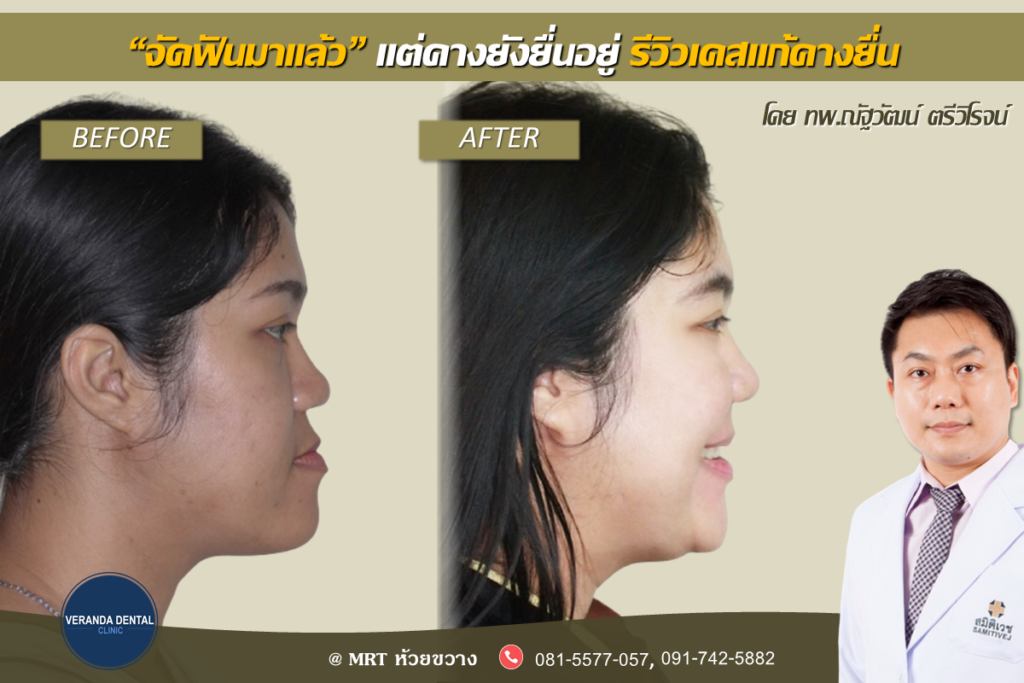 จัดฟันแล้วแต่คางยังยื่นอยู่