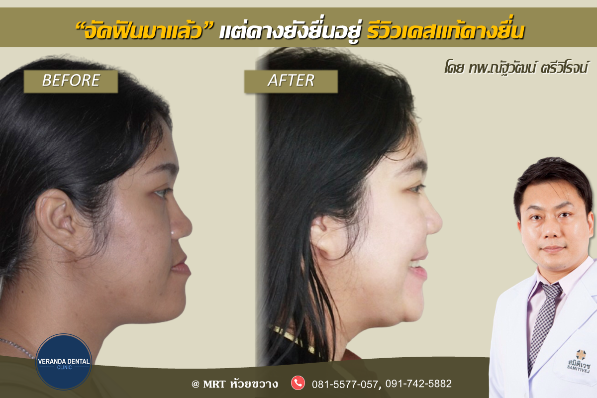 จัดฟันแล้วแต่คางยังยื่นอยู่
