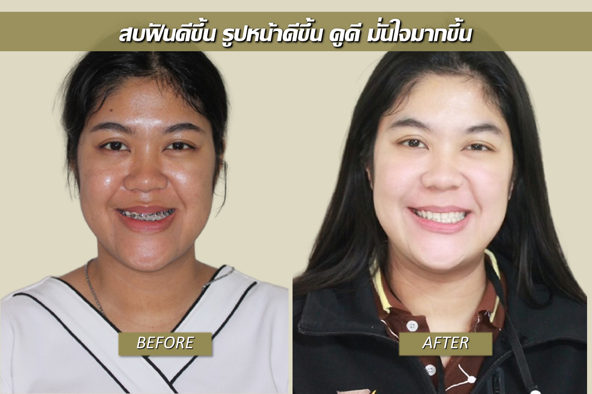 จัดฟันร่วมกับผ่าตัดขากรรไกร