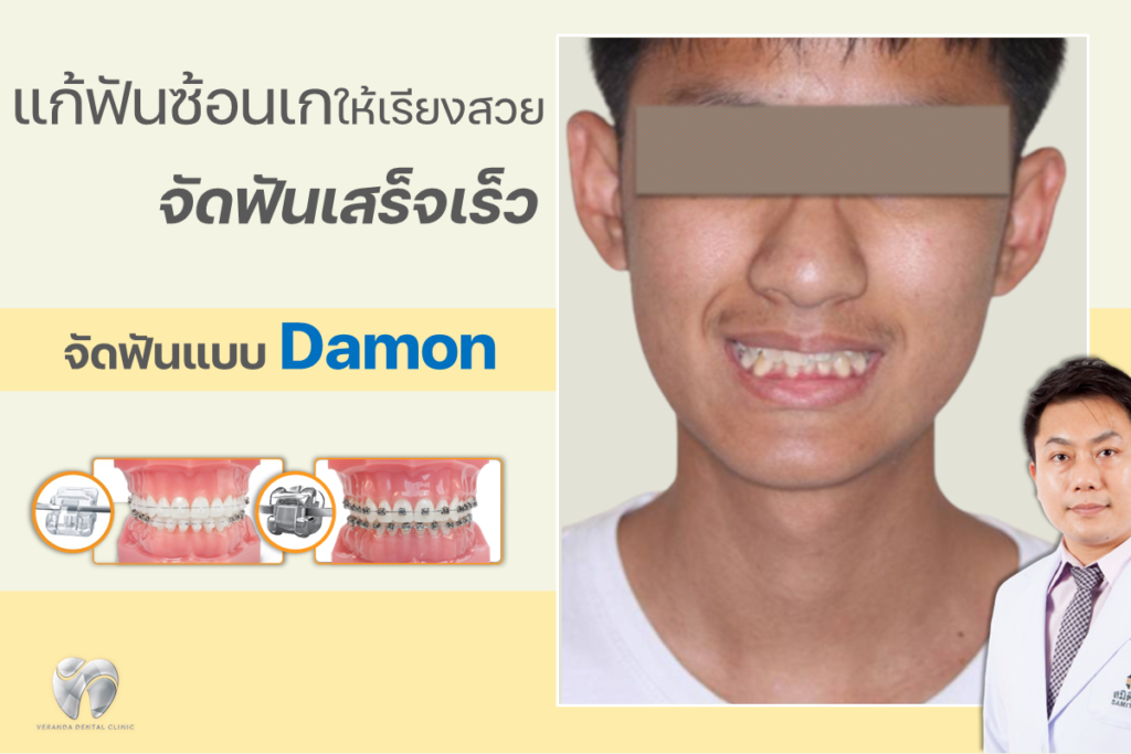 รีวิวจัดฟันดาม่อนจัดฟันเสร็จเร็วแก้ฟันซ้อนเก