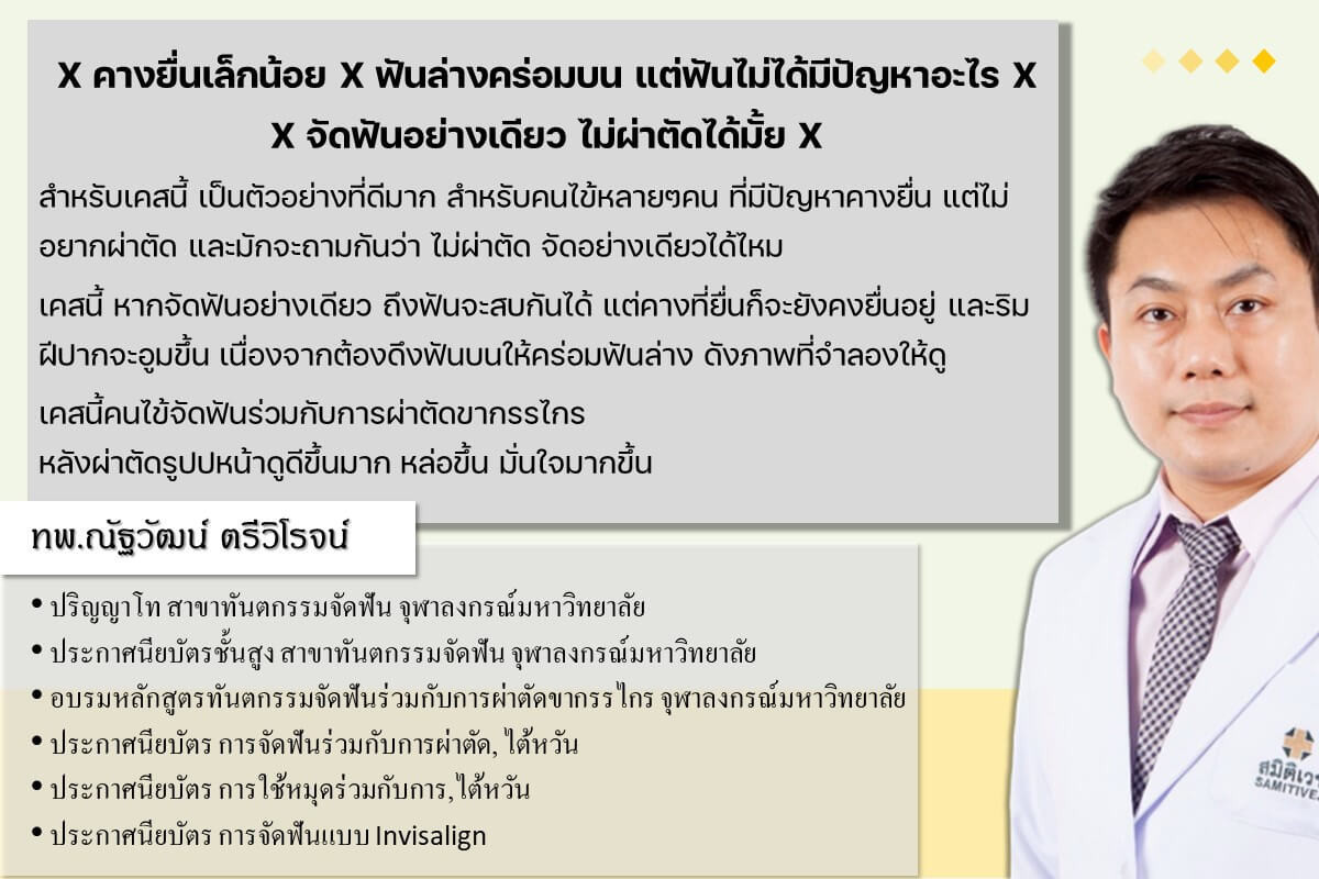 รีวิวเคสผ่าตัด ทพ.ณัฐวัฒน์ ตรีวิโรจน์