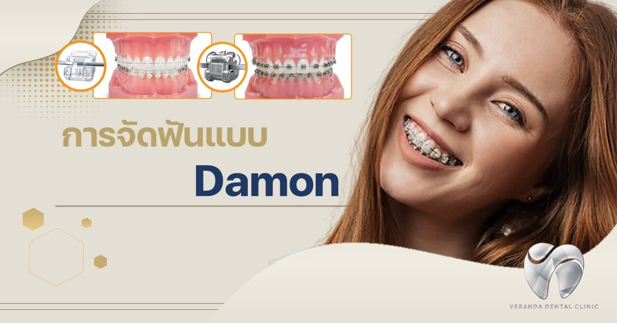 จัดฟันแบบดามอน