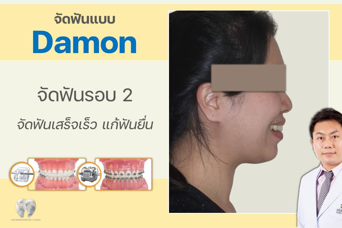 จัดฟันดามอนรอบสอง 
