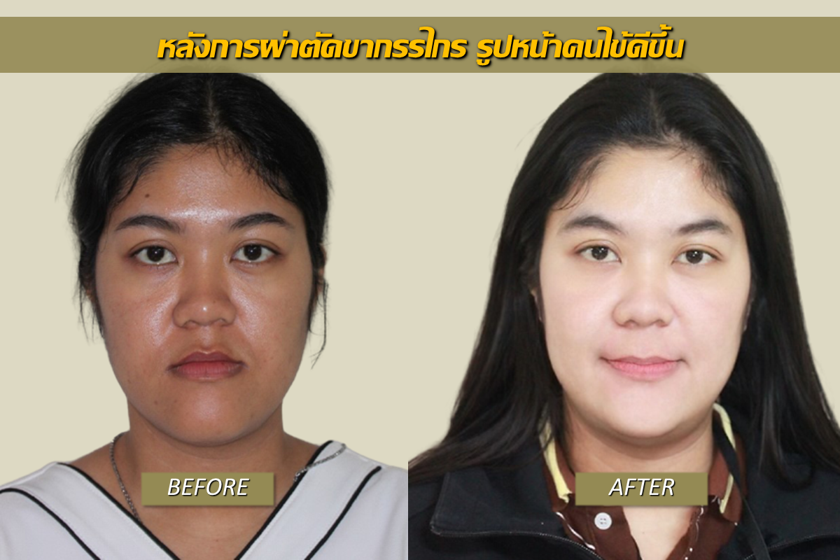 รีวิวผ่าตัดแก้คางยื่น