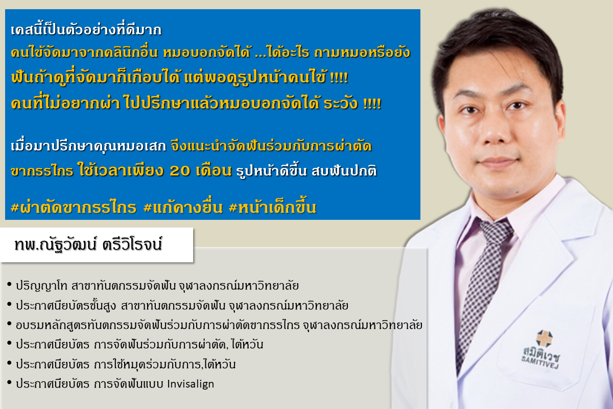 รีวิวผ่าตัดขากรรไกรก่อนจัดฟัน