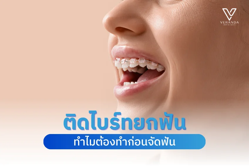 ติดไบร์ทยกฟัน คืออะไร