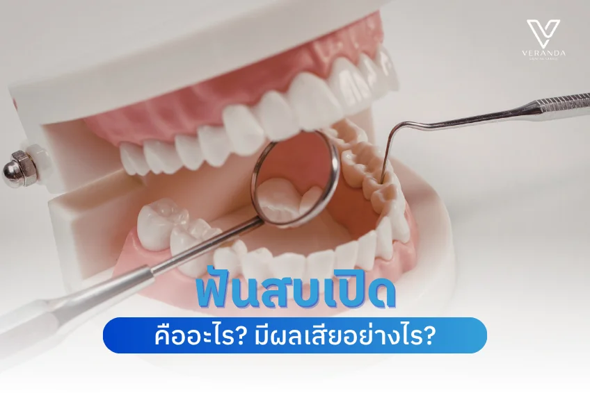 ฟันสบเปิด (Open Bite